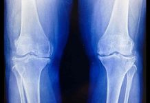 Breakthrough Cartilage Regeneration Therapy Could End Arthritis and Joint Surgery